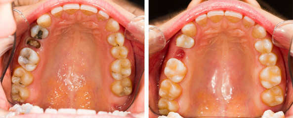 Tooth Extraction and Resin