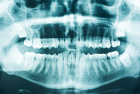 Panoramic Dental X-Ray Of Human Teeth