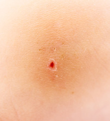 Fototapeta premium insect bite