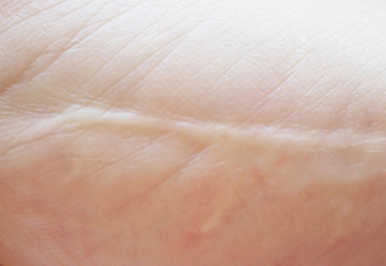 scar on skin