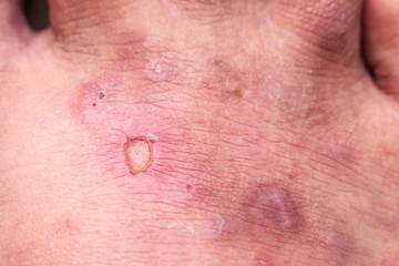Fototapeta premium closeup skin athleteâ€™s foot psoriasis fungus, hong kong foot,