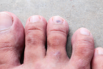 closeup skin athlete&rsquo;s foot psoriasis fungus, hong kong foot,