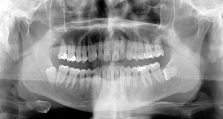 Radiograf&iacute;a Dental