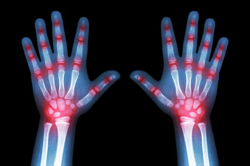 Rheumatoid arthritis ( X-ray both child hands and multiple joint