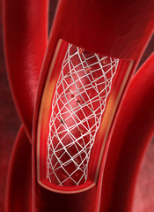Arterie mit Stent