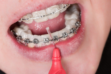 Zahnklammer und Dentalbürste