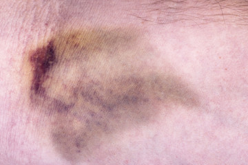 Closeup on a bruise