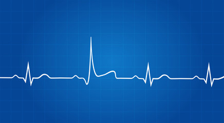 Blueprint Of Heart Attack On Electrocardiogram