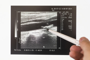 Ultraschallbild einer Halsschlagader( Arteria Carotis communis) 