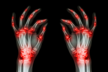 multiple joint arthritis both adult hands ( Gout , Rheumatoid )