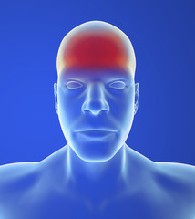 Tipo di mal di testa a cefalo tensivo