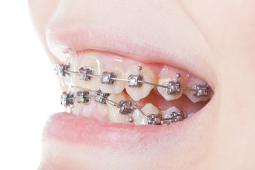 side view of dental braces on teeth close up © vvoe