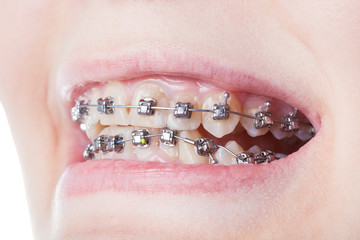 dental steel brackets on teeth close up © vvoe