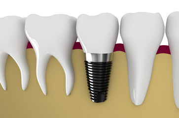 dental implant