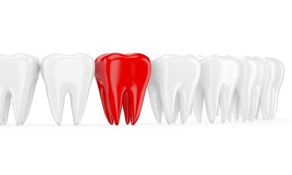 Aching tooth in row of healthy teeth. 3d
