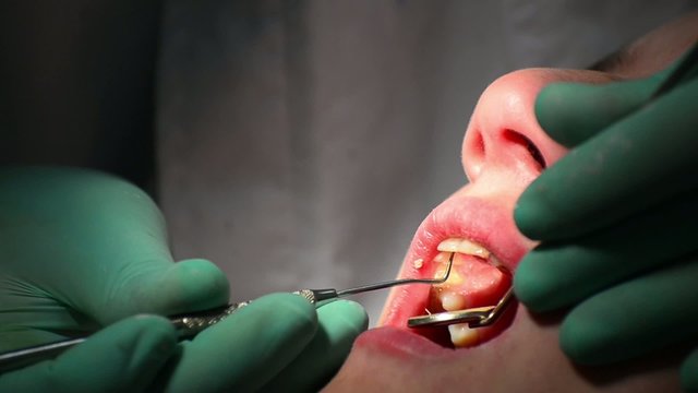 dentist check gum for gingivitis desease