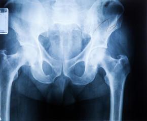 X ray MRI - Image of Spine pain and Hip bone..
