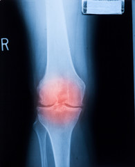 Ankle feet & knee joint X-ray human photo film..