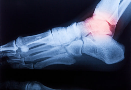 Ankle feet & knee joint X-ray human photo film..