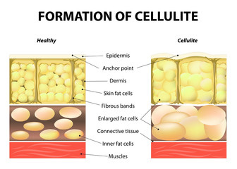 Formation of cellulite - obrazy, fototapety, plakaty