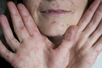 Hand Fu&szlig; Mund Krankheit, Erwachsene