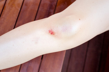 Injured female knee