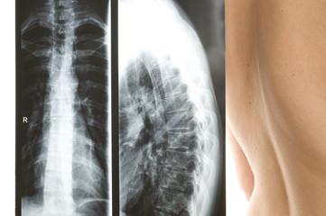 Röntgenbilder und Wirbelsäule, leichte Skoliose