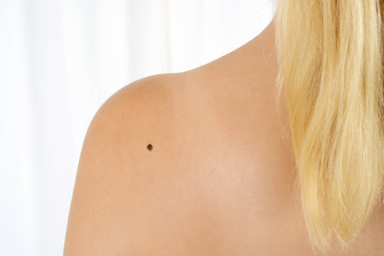 Verdacht auf Haut-Krebs auf Schulter