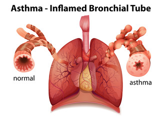 Bronchial asthma - obrazy, fototapety, plakaty