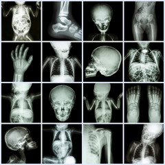 Collection X-ray part of child body