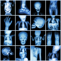 Collection X-ray part of child body