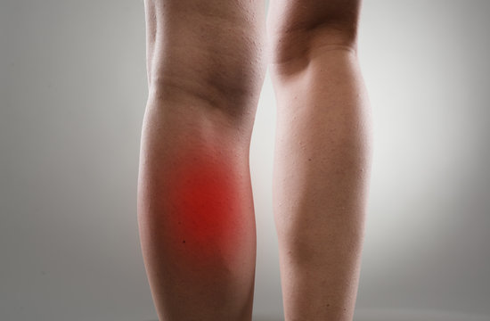 Injured female legs with red spots. Muscle strain and stretch