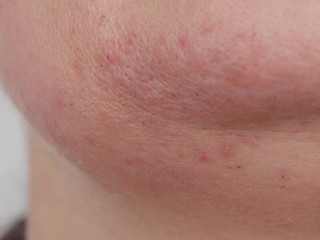 bad skin close-up
