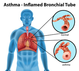 Asthma-inflamed bronchial tube