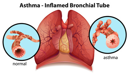 An asthma-inflamed bronchial tube - obrazy, fototapety, plakaty