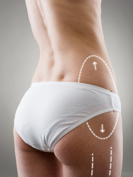 Skin and body care. Cosmetic surgery. Close-up of woman hips