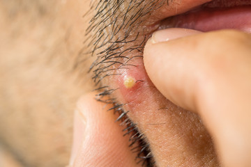 Extreme closeup of caucasian man with stub squeezing a pimple