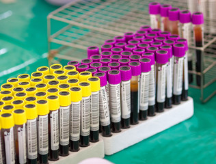 Fototapeta na wymiar test tubes with blood on a tray