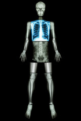 Lung healthy (X-ray Whole body )
