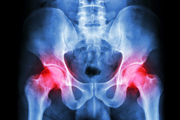 human's pelvis and arthritis at both hip joint (Gout,Rheumatoid) - obrazy, fototapety, plakaty