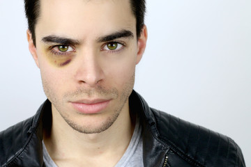 portrait of a handsome young man with a shiner