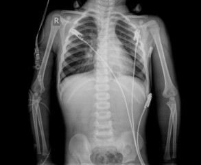 x-ray chest and abdomen man