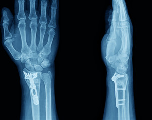 broken hand