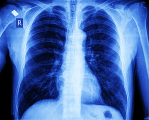 x-ray chest