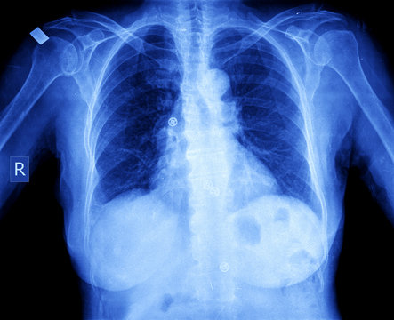 x-ray chest woman