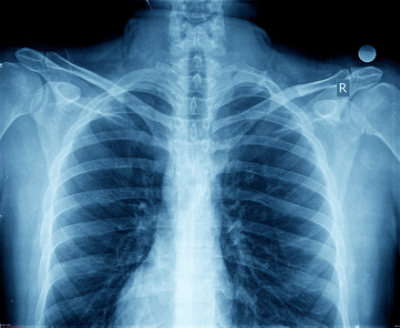 x-ray chest