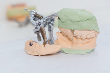 dental cast model