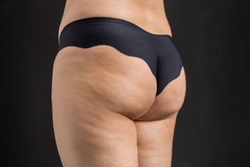 Obraz premium Cellulite