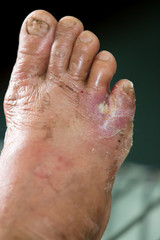 wound of diabetic foot