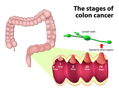 The Stages Of Colorectal Cancer